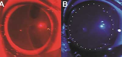 Optic nerve disease - chromatic light testing